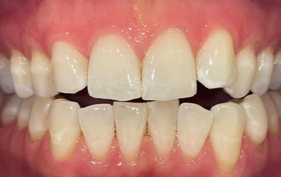Bright smile before teeth whitening