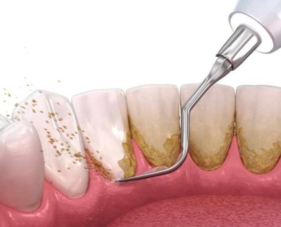 Animated smile during scaling and root planing treatment