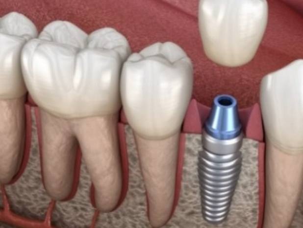Animated smile during dental implant tooth replacement