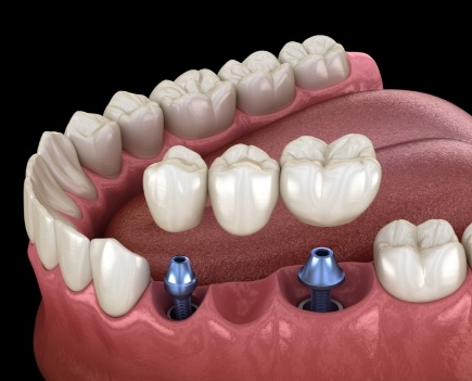 Animated smile during dental implant supported fixed bridge placement